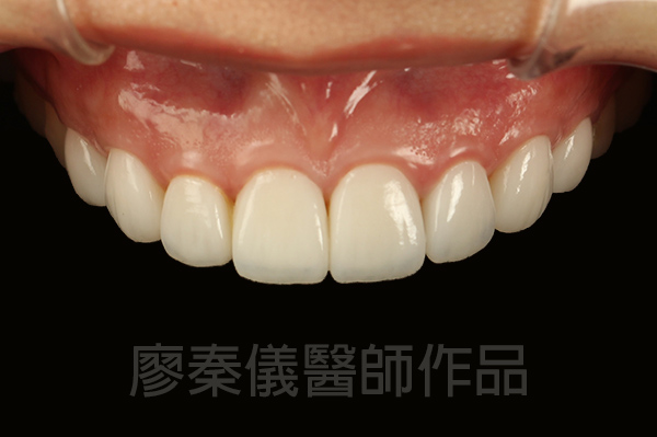 微笑曲線設計,全瓷貼片