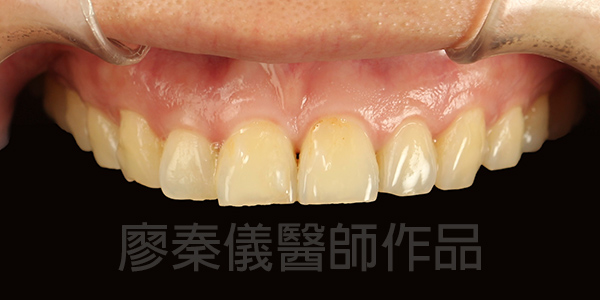微笑曲線設計,全瓷貼片