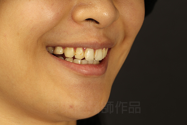 牙齦美容,全瓷冠貼片,去除黑色素