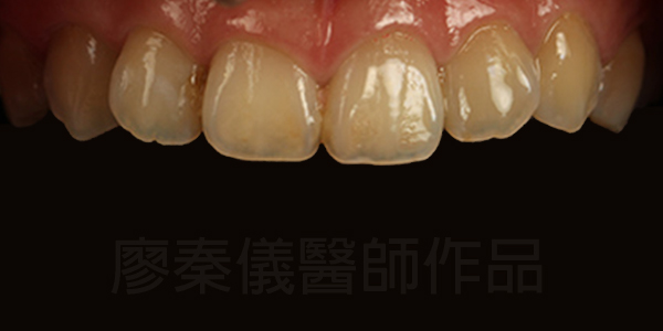 晶鑽美白貼片