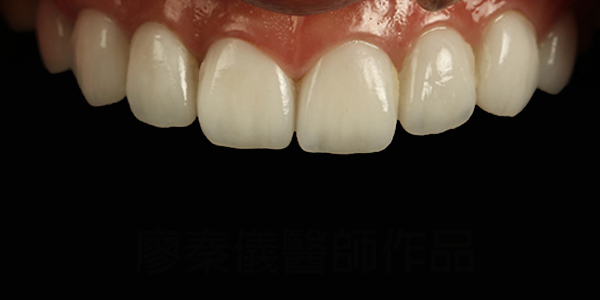 晶鑽美白貼片