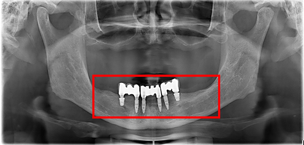 下顎植牙、上顎活動假牙