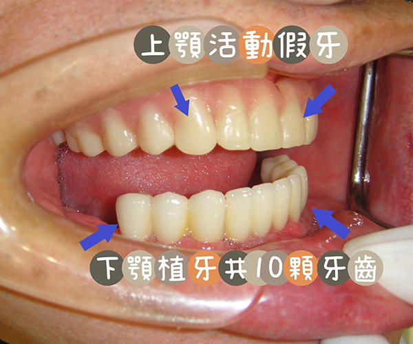 下顎植牙、上顎活動假牙