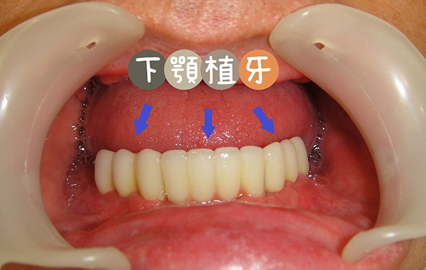 下顎植牙、上顎活動假牙