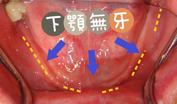 下顎植牙、上顎活動假牙