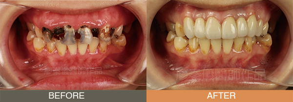 晶鑽全瓷冠/牙齦美容