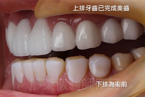 牙齦美容,微笑曲線設計,全瓷齒雕