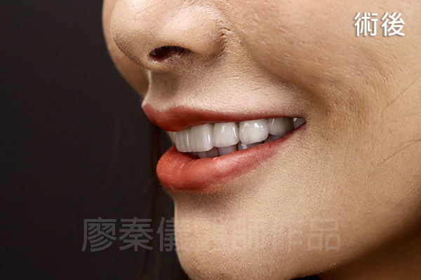 牙齦美容,微笑曲線設計,全瓷齒雕