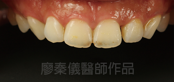 新竹牙齦美容,新竹微笑曲線設計,新竹全瓷齒雕