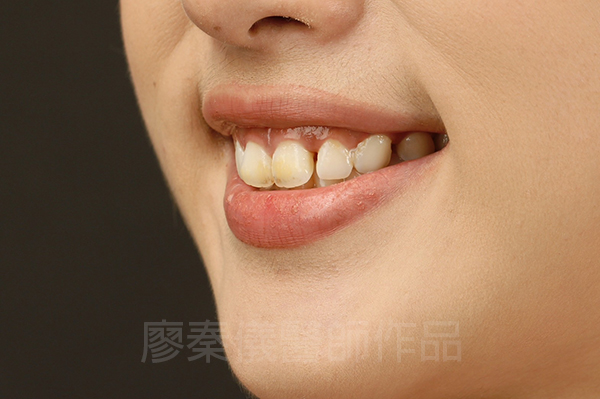 新竹牙齦美容,新竹微笑曲線設計,新竹全瓷齒雕