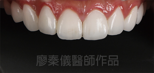 新竹牙齦美容,新竹微笑曲線設計,新竹全瓷齒雕