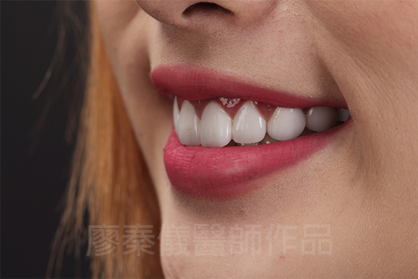 新竹牙齦美容,新竹微笑曲線設計,新竹全瓷齒雕