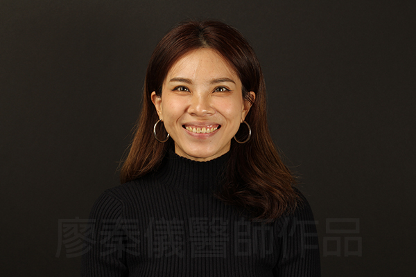 美白貼片,牙齦美容