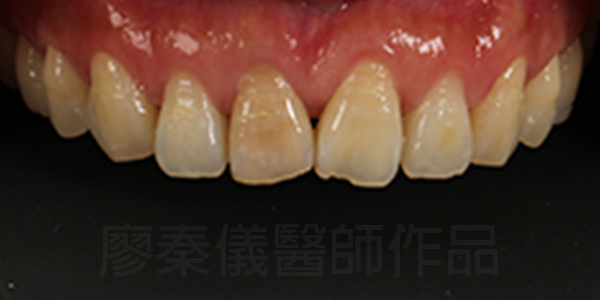 美白貼片,牙齦美容