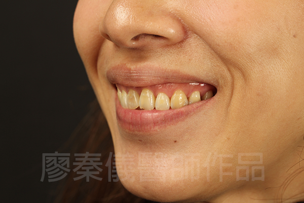 美白貼片,牙齦美容