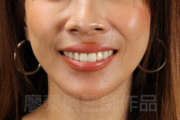 美白貼片,牙齦美容