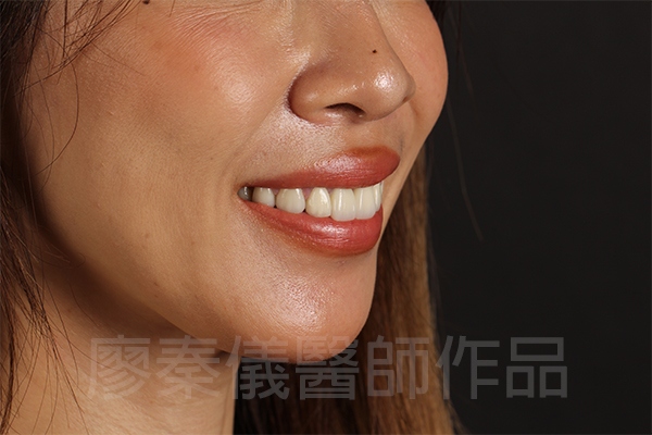美白貼片,牙齦美容