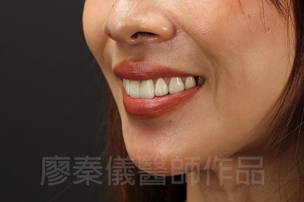 美白貼片,牙齦美容