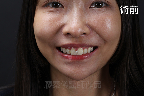 陶瓷貼片