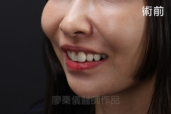 陶瓷貼片