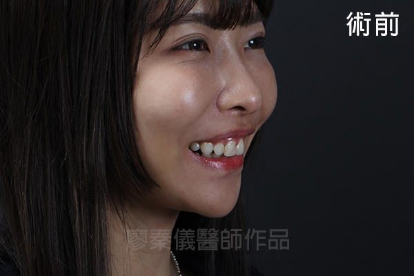 陶瓷貼片