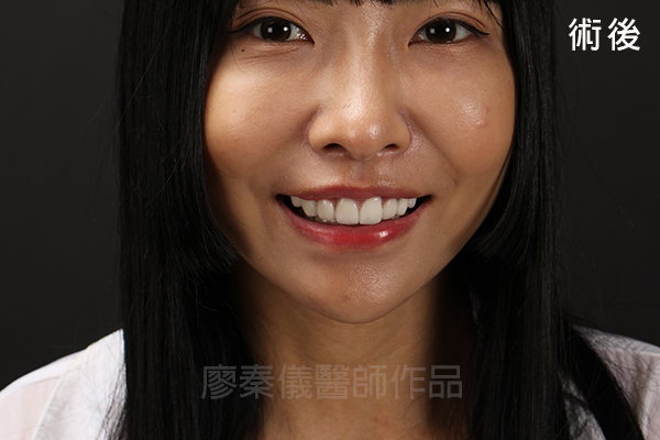陶瓷貼片