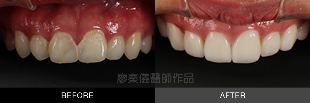 陶瓷貼片
