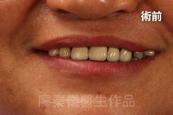 舒眠 All-on-4 上顎重建,牙周治療