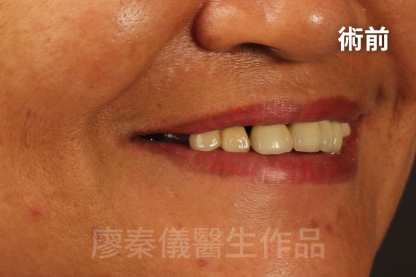舒眠 All-on-4 上顎重建,牙周治療