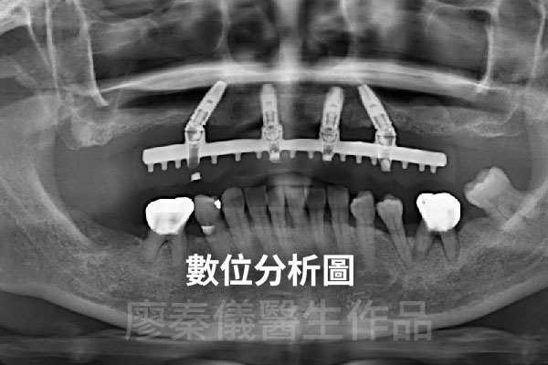 舒眠 All-on-4 上顎重建,牙周治療