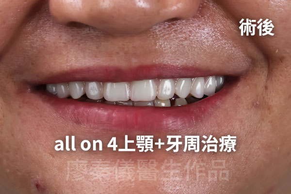 舒眠 All-on-4 上顎重建,牙周治療