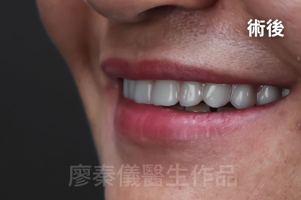 舒眠 All-on-4 上顎重建,牙周治療