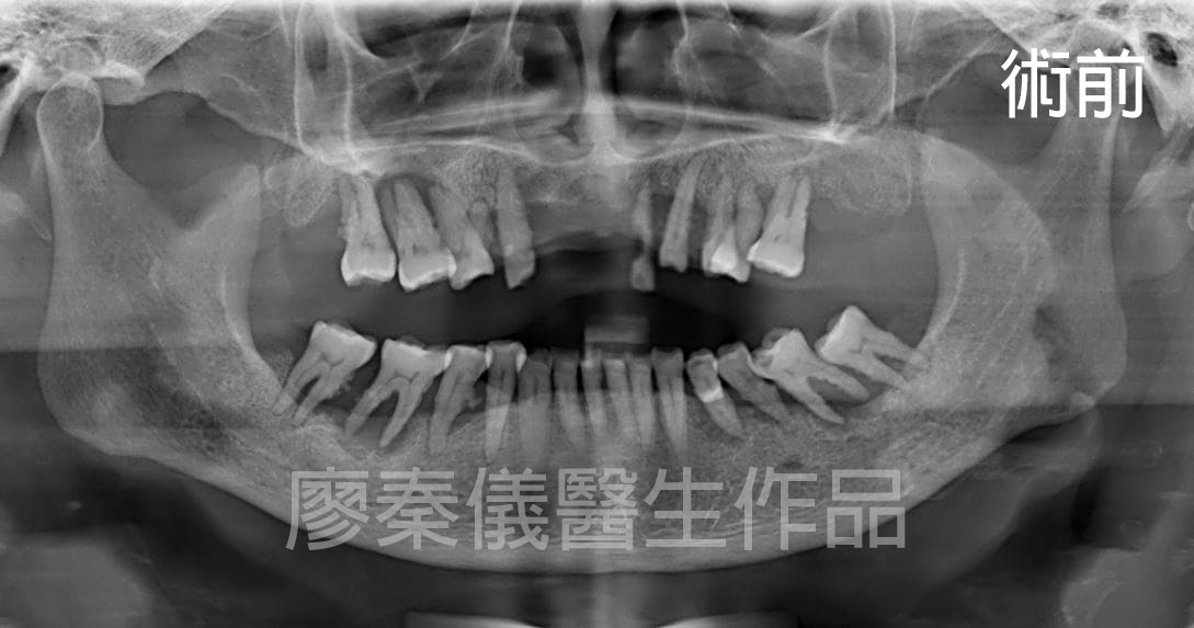 舒眠上下全口 All-on-4 重建