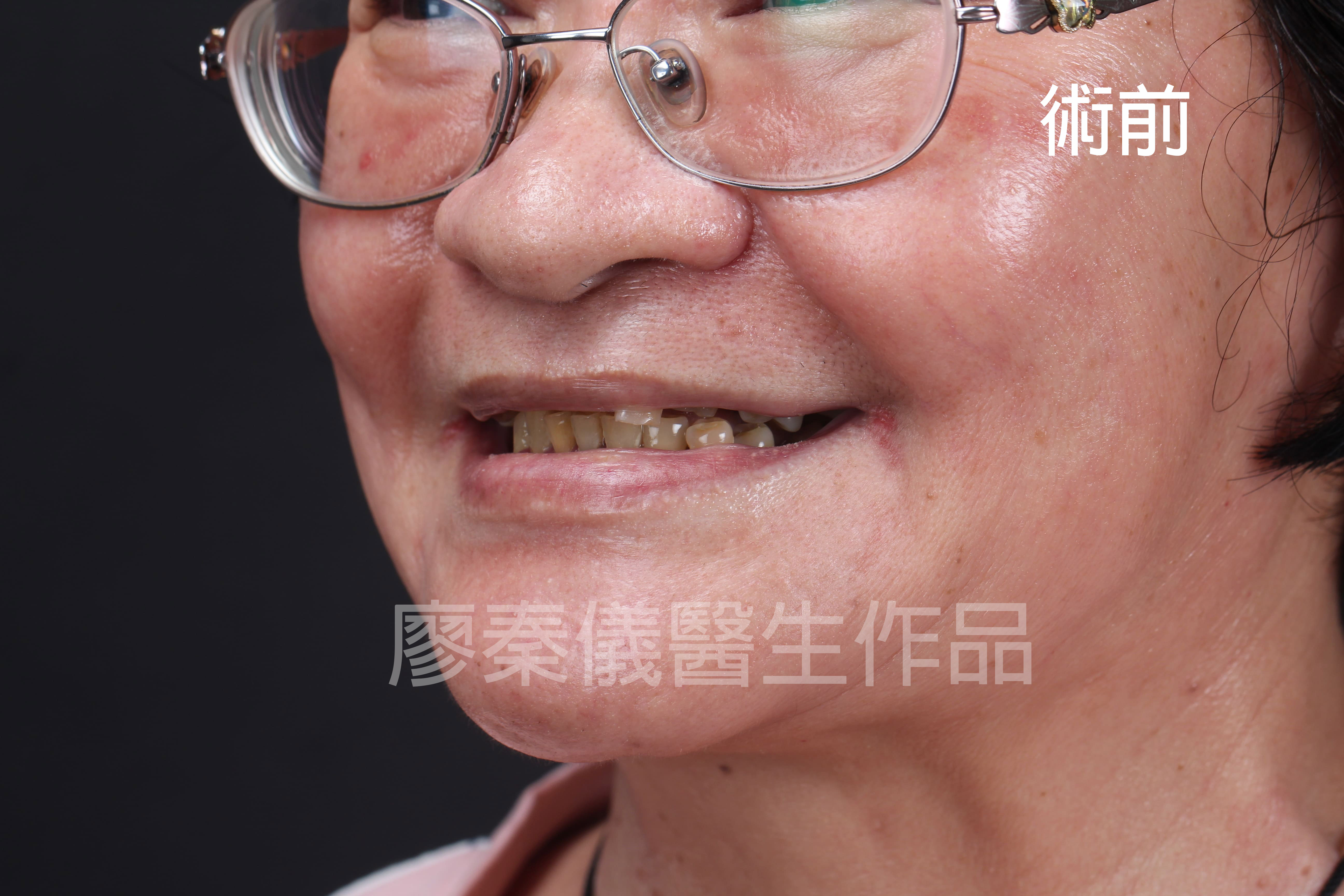 舒眠上下全口 All-on-4 重建