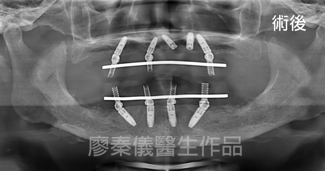 舒眠上下全口 All-on-4 重建