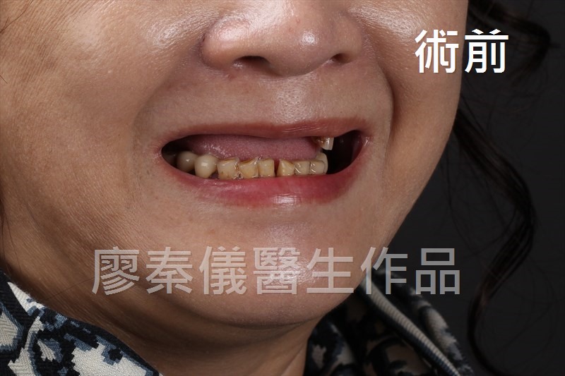 舒眠 All-on-4 上顎重建