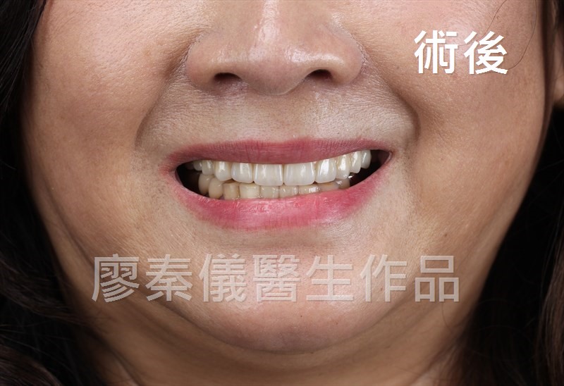舒眠 All-on-4 上顎重建