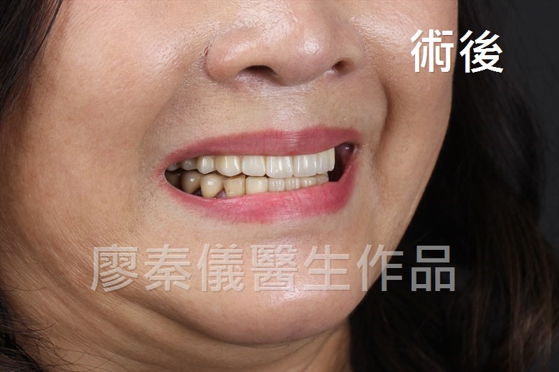 舒眠 All-on-4 上顎重建