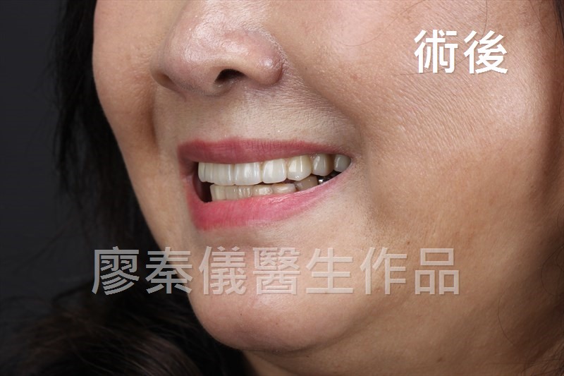舒眠 All-on-4 上顎重建