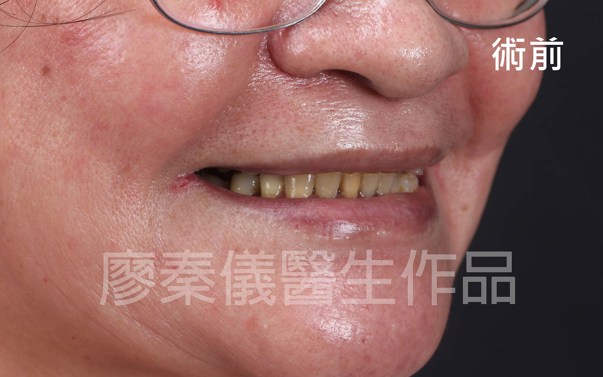 舒眠上下全口 All-on-4 重建