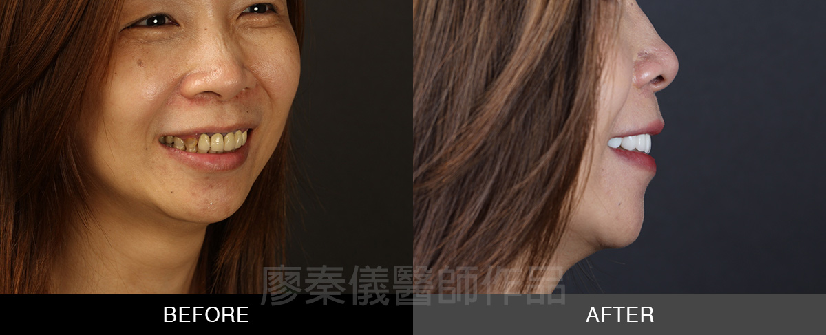 牙齦美容+小美容 晶鑽全瓷冠