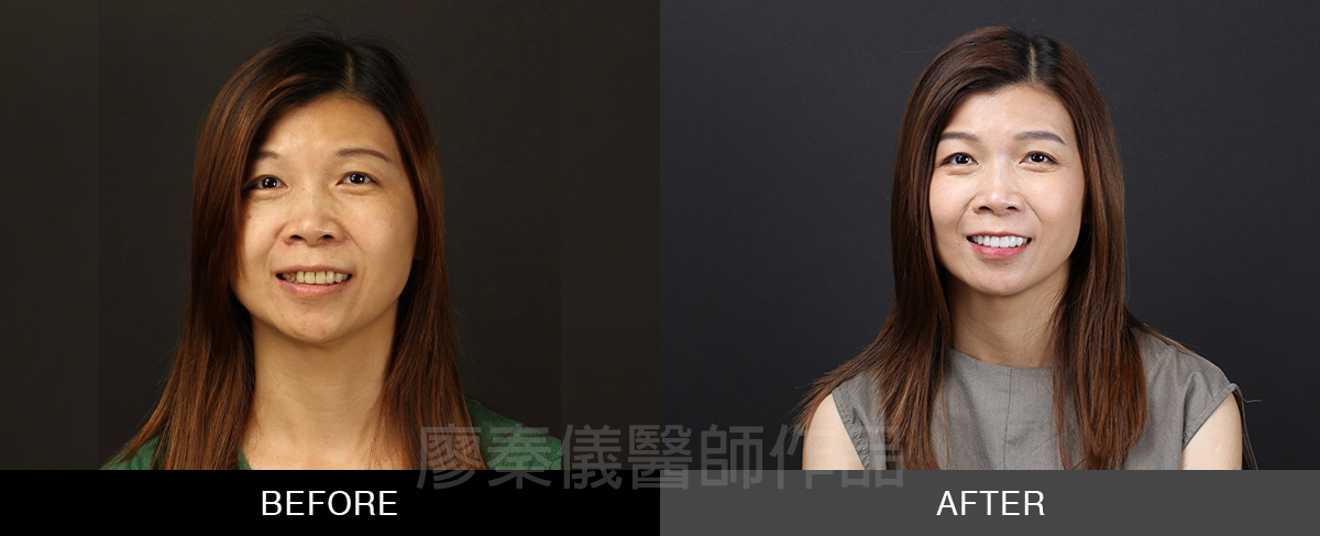 牙齦美容+小美容 晶鑽全瓷冠