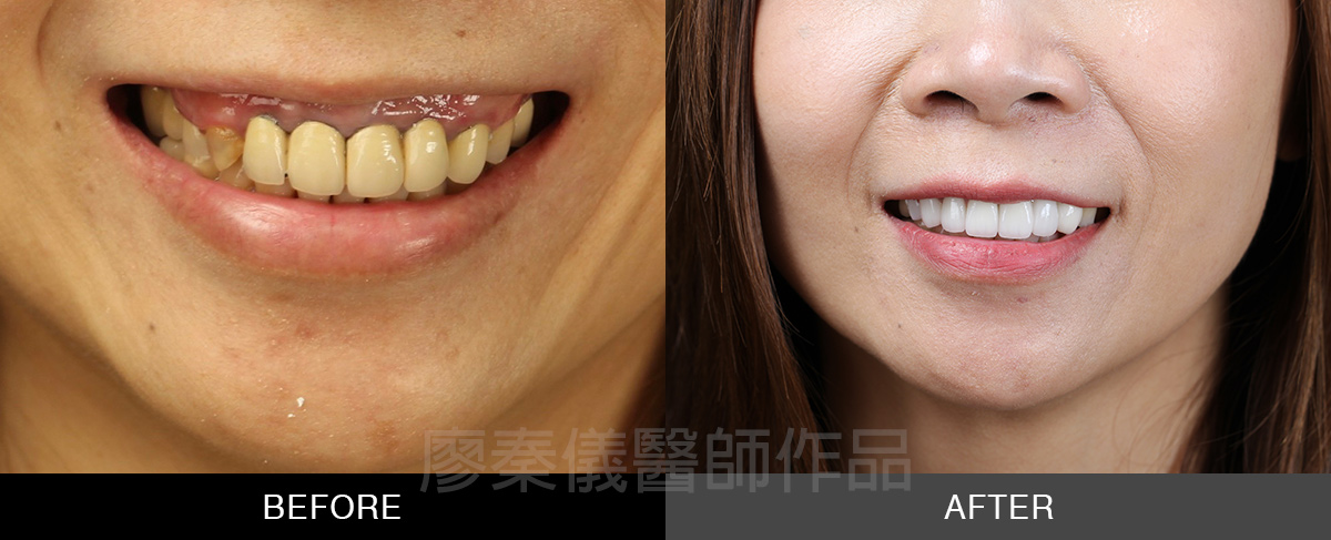 牙齦美容+小美容 晶鑽全瓷冠