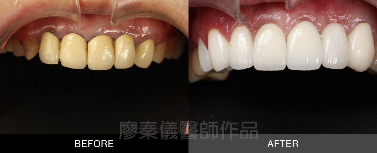 牙齦美容+小美容 晶鑽全瓷冠
