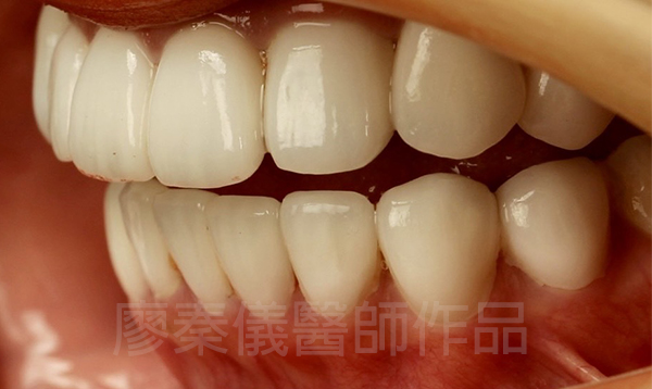 晶鑽美白貼片