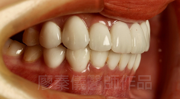 晶鑽美白貼片
