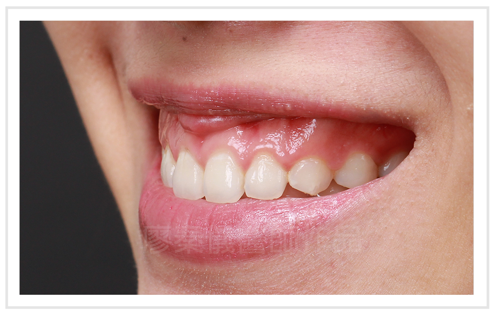 牙齦對稱手術,雷射牙周治療,竹北雷射牙周治療,美容牙科,竹北美容牙科,全口牙周雷射治療,牙齦美容