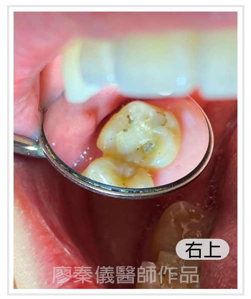 3D齒雕,竹北3D齒雕,美容牙科,晶鑽全瓷,新竹牙裂,竹北牙裂,新竹牙斷,竹北牙斷