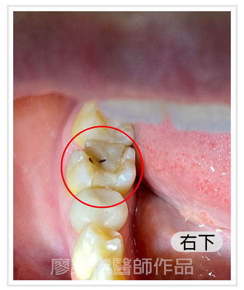 3D齒雕,竹北3D齒雕,美容牙科,晶鑽全瓷,新竹牙裂,竹北牙裂,新竹牙斷,竹北牙斷