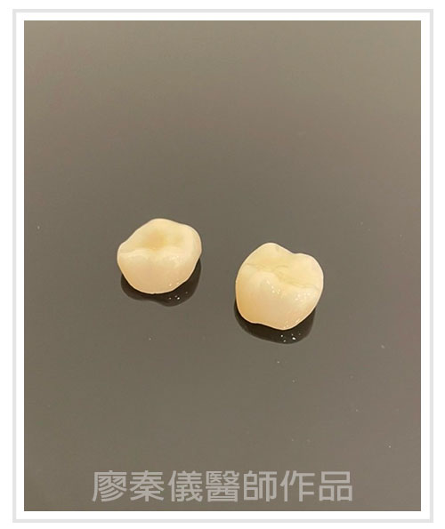 3D齒雕,竹北3D齒雕,美容牙科,晶鑽全瓷,新竹牙裂,竹北牙裂,新竹牙斷,竹北牙斷